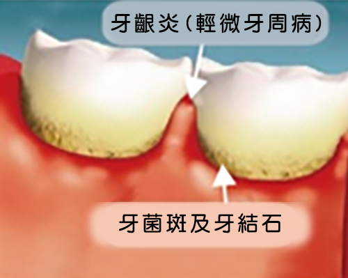 牙周病圖示1